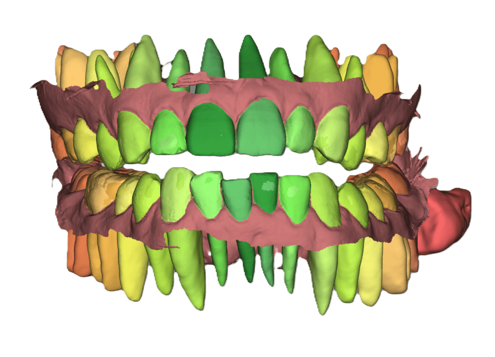 Alignment of CBCT and IOS