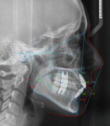 Automated Lateral Cephalometric Tracing