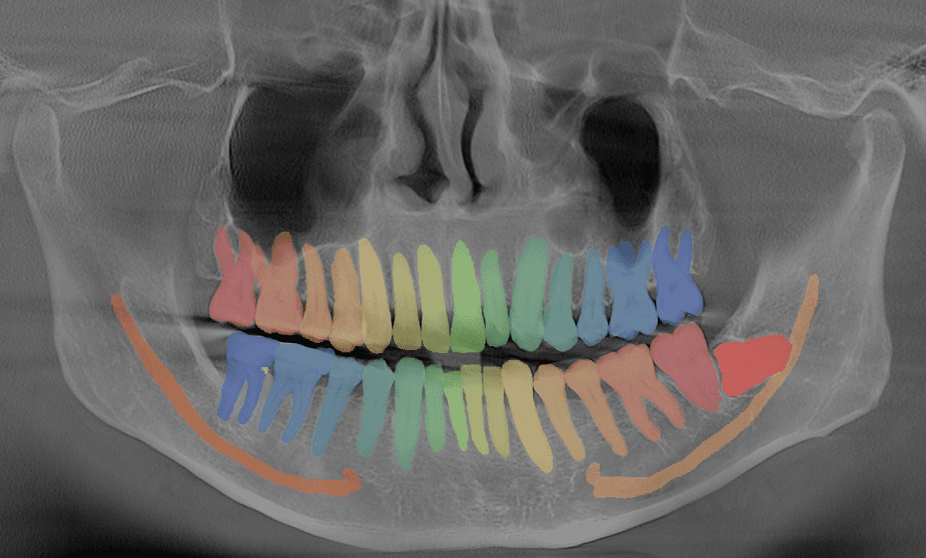 Diagnosis on Panoramic X-rays